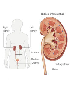 Symptoms of kidney stones 