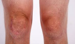 Osteoarthritis OF the knee