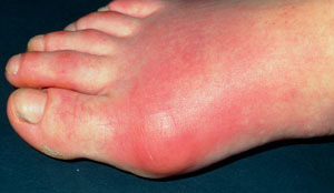 Treating gout 